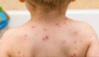 উদ্বেগ বাড়াচ্ছে মাঙ্কিপক্স, শিশুদের যেসব উপসর্গ দেখলে সতর্ক হবেন